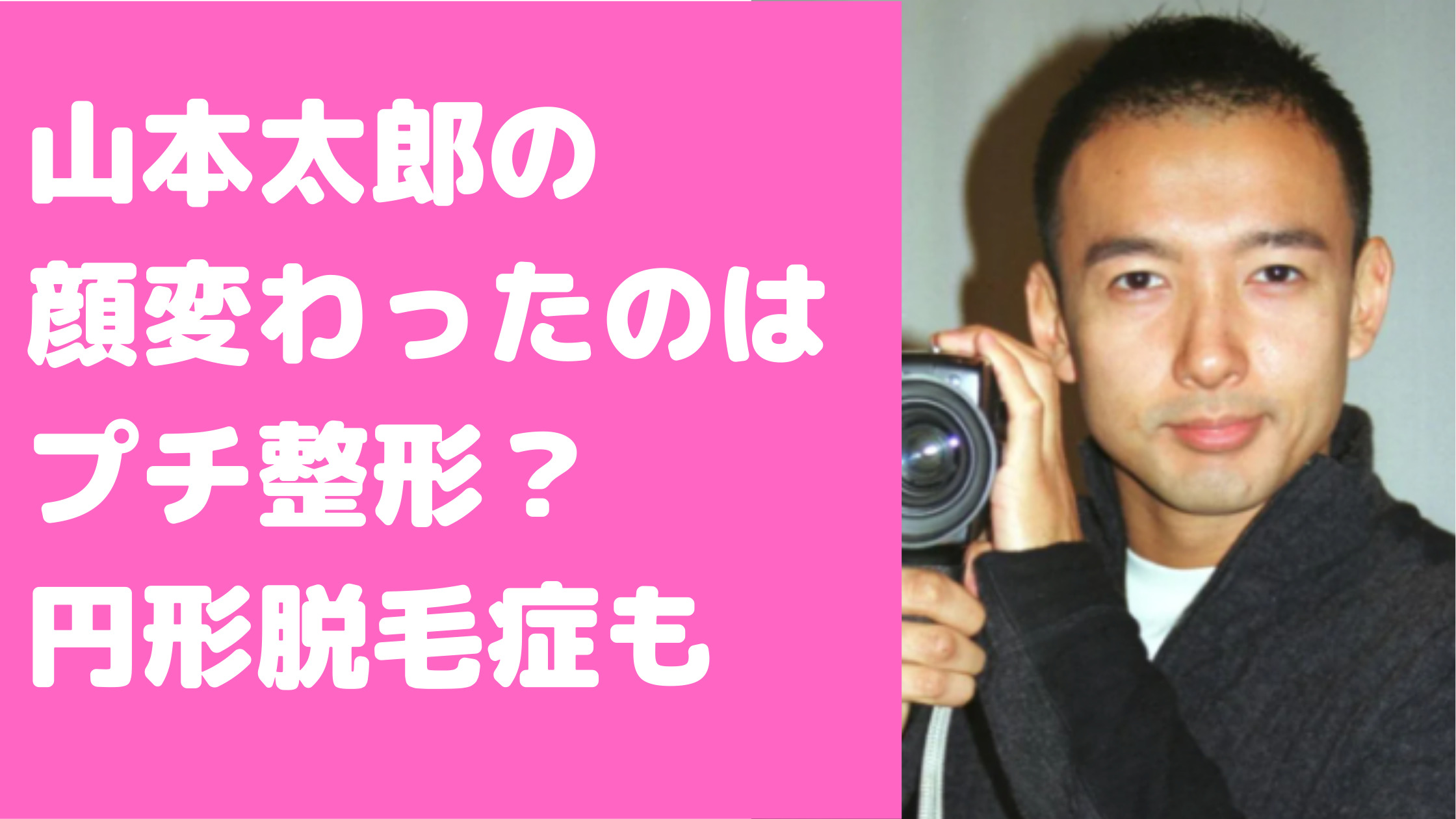 山本太郎整形　おでこ　鼻　顔変わった　いつから　円形脱毛症